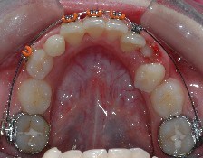 affollamento dentale, estrazioni